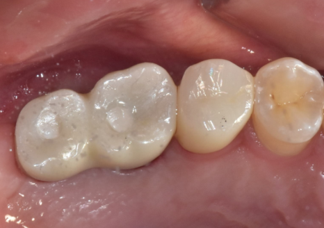 Myeongil-dong Implant Treatment in Your 20s: The Reason It Ended Up Requiring Bone Grafting After Thinking, “I’m Young, So It’ll Be Fine” image 13
