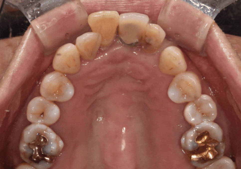 고덕동 임플란트, 튀어나온 앞니, 비용은 줄이고 자연스럽게 개선한 실제 사례 관련 이미지 10