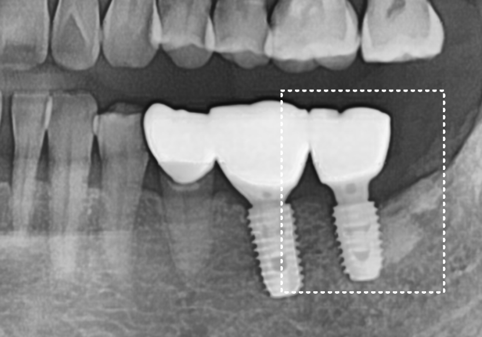 발치 후 빈 공간, 이 빼고 오래 냅두면 이렇게 됩니다. 관련 이미지 13