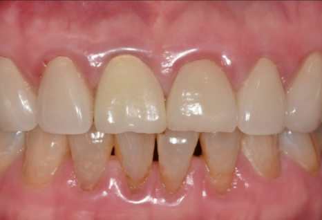 고덕동 앞니 보철, 브릿지와 싱글 크라운, 어떤 선택이 나에게 더 유리할까? 관련 이미지 20