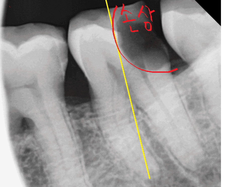 천호동 치과 충치로 인하여 손상된 치아 임플란트로 대처하기 관련 이미지 1