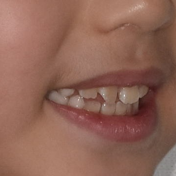 When Should My Child Start Orthodontic Treatment? When to Begin Now vs. When It Is Fine to Wait image 1