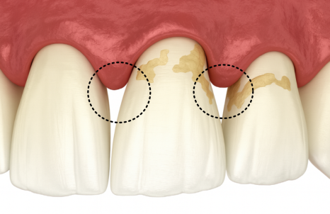 스케일링했더니 잇몸 구멍, 치아 사이 구멍이 생겼어요. 스케일링에 관한 오해 3가지 관련 이미지 3