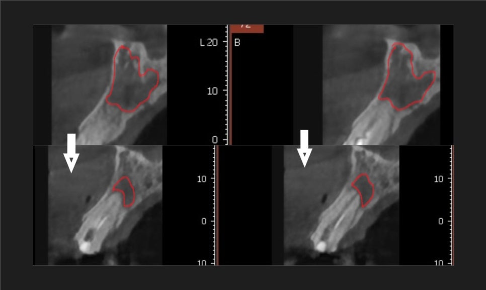 강동구 재신경치료, 왜 첫 치료보다 성공률이 낮다고 할까요? 관련 이미지 9