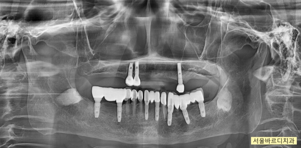 상일동 치과 부분 틀니에서 임플란트 바꿔서 사용하기 관련 이미지 2