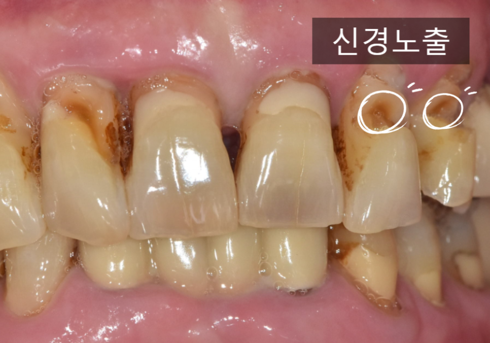 고덕역치과, 잇몸 패임(치경부 마모) 레진 치료, 왜 자꾸 떨어지나요? 관련 이미지 6