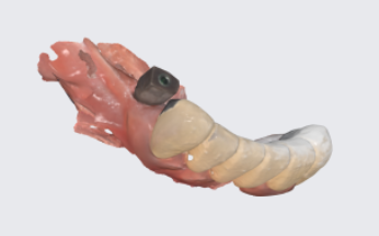 임플란트 기둥 맞춤으로 어느 한 과정도 놓칠 수 없으니까! 관련 이미지 6