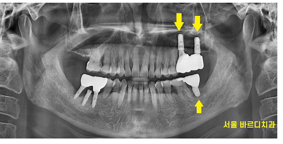 잇몸 고름 냄새 약으로 없앨 수는 없나요? 무시 무시한 치주염 관련 이미지 6