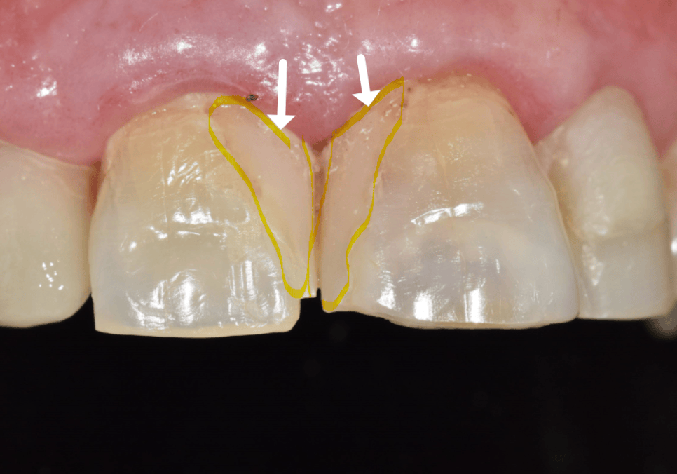 명일동 라미네이트 vs 크라운, 수명을 좌우하는 선택 기준 3가지 관련 이미지 4