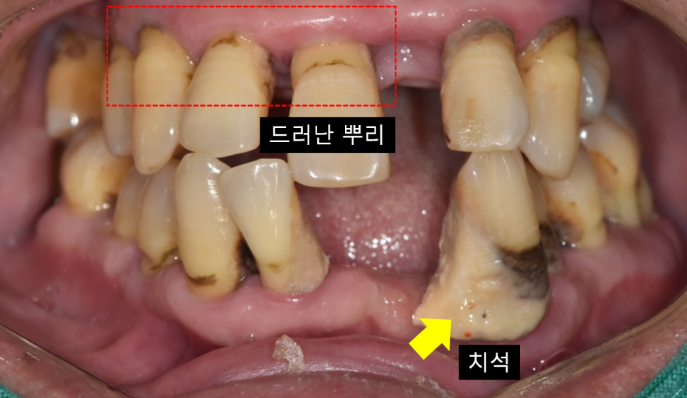 임플란트 양쪽 동시에 해도 될까? 우려되시는 분들 클릭 관련 이미지 4