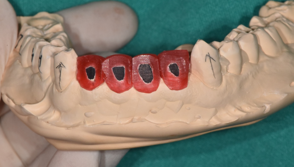 앞니 사이 간격 넓어짐 치아가 벌어져서 보기 싫을 때 크라운 치료 관련 이미지 7