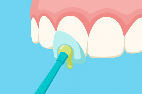 고덕동 무삭제 라미네이트, 실패 없이 하려면 꼭 확인할 3가지 관련 이미지 9