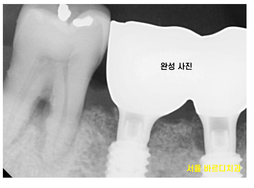 하남시청치과 치아 욱신거림 임플란트로 치료해드렸습니다. 관련 이미지 9