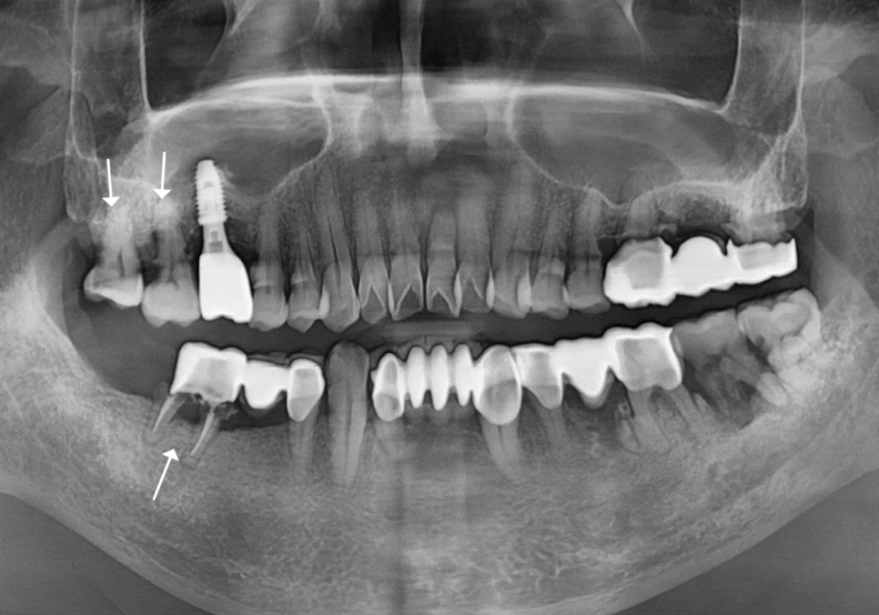 고덕동 어금니 브릿지 교체, 관련 이미지 14