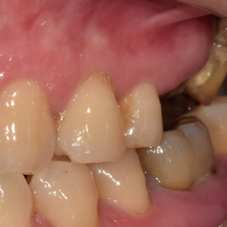 상일동역 임플란트 이 뽑고 임시틀니(플리퍼)는 꼭 해야 하나요? 관련 이미지 4