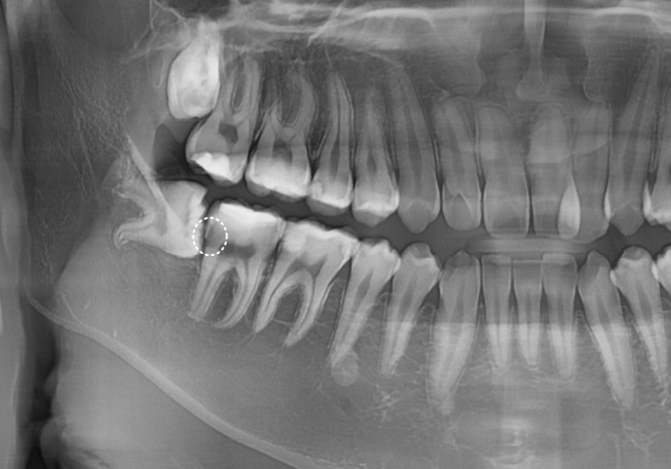 고덕동 사랑니 매복 발치, 안 아픈데 꼭 빼야 하나요? 관련 이미지 5