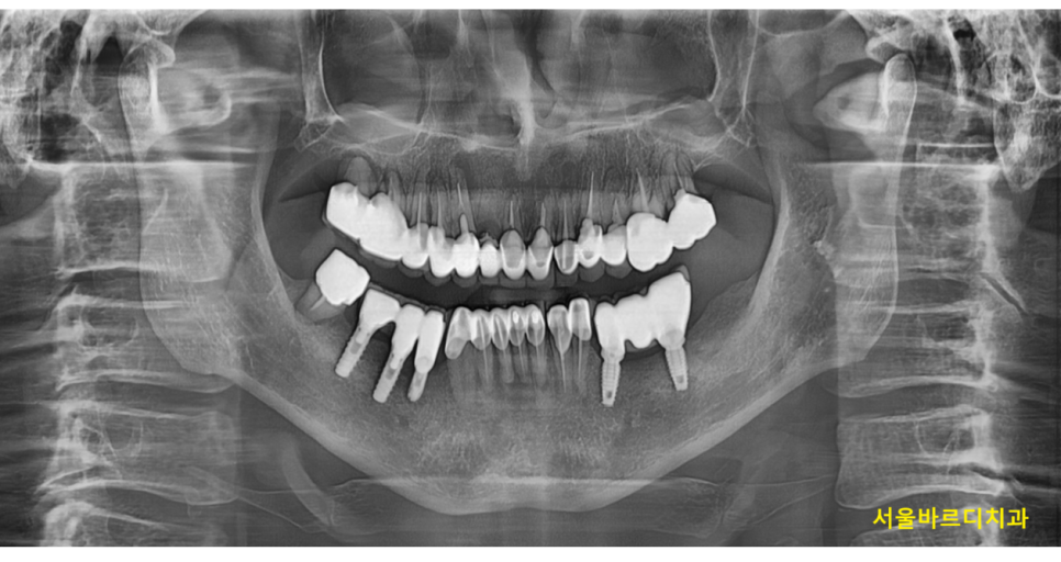 위아래 임플란트 동시에 하여 치료기간 단축하기 관련 이미지 1