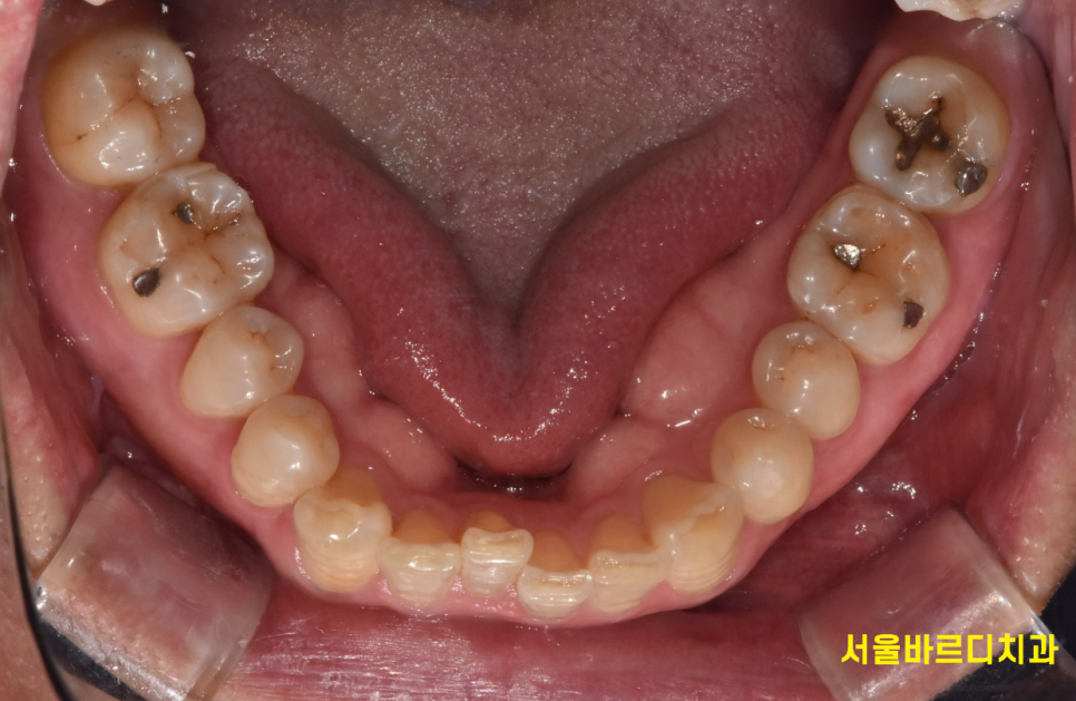 강동구 교정치과 교정 진단비와 관련된 공지 관련 이미지 2