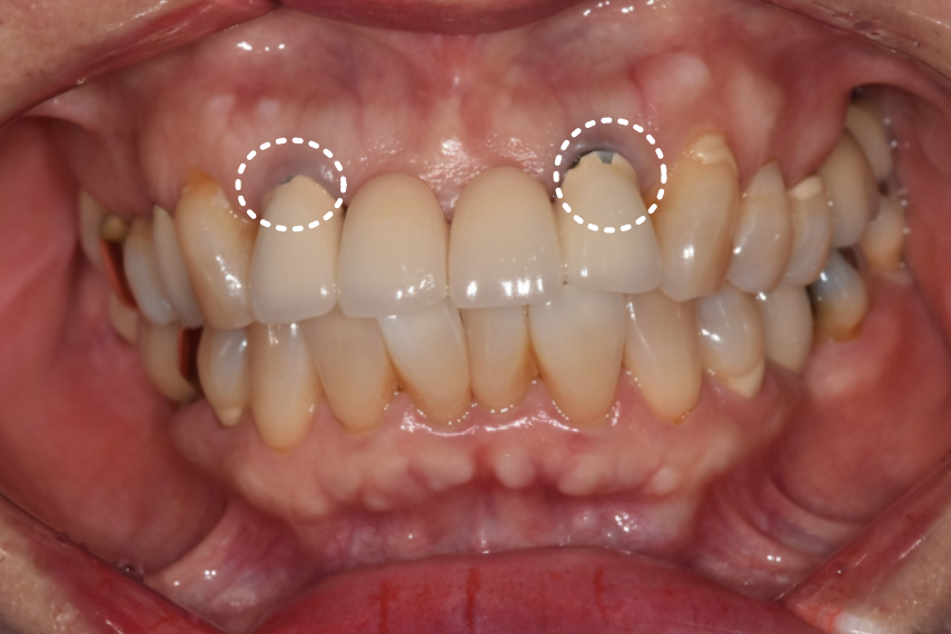 명일동 앞니 브릿지, 새로 교체 할 때 꼭 확인해 봐야 할 관련 이미지 2