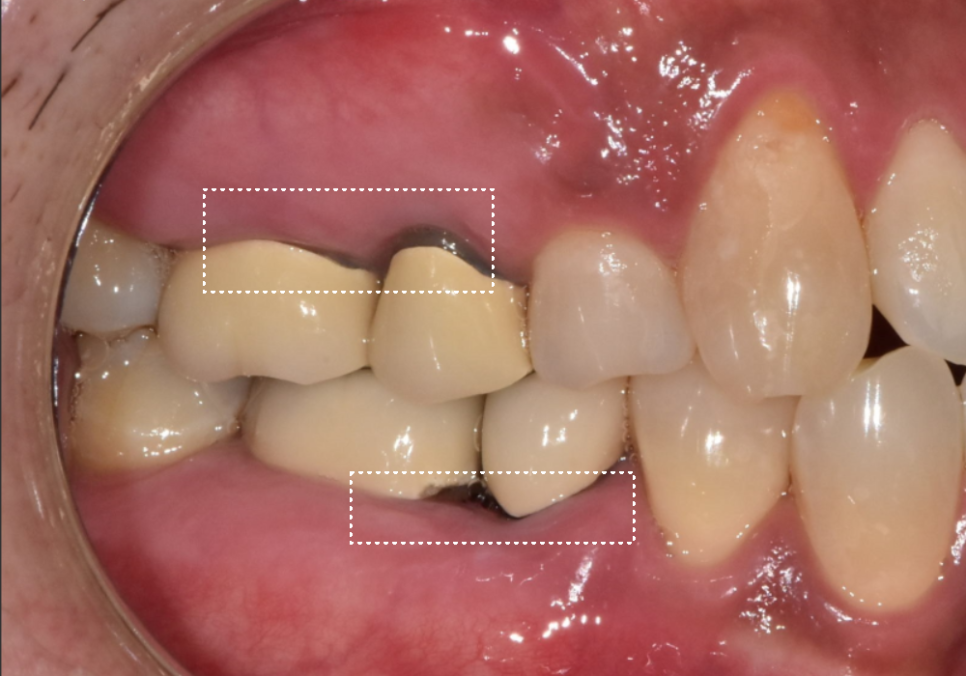 명일동 치과, 잇몸이 검게 변했다면? 앞니 변색 원인은 바로 관련 이미지 7