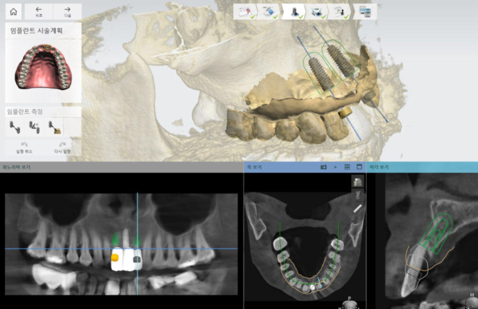 고덕동 임플란트, 튀어나온 앞니, 비용은 줄이고 자연스럽게 개선한 실제 사례 관련 이미지 5