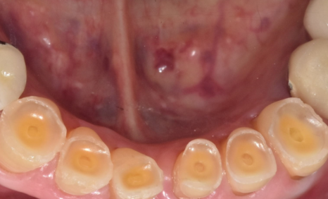 합죽이입 처럼 보이는 이유, 낮아진 관련 이미지 5