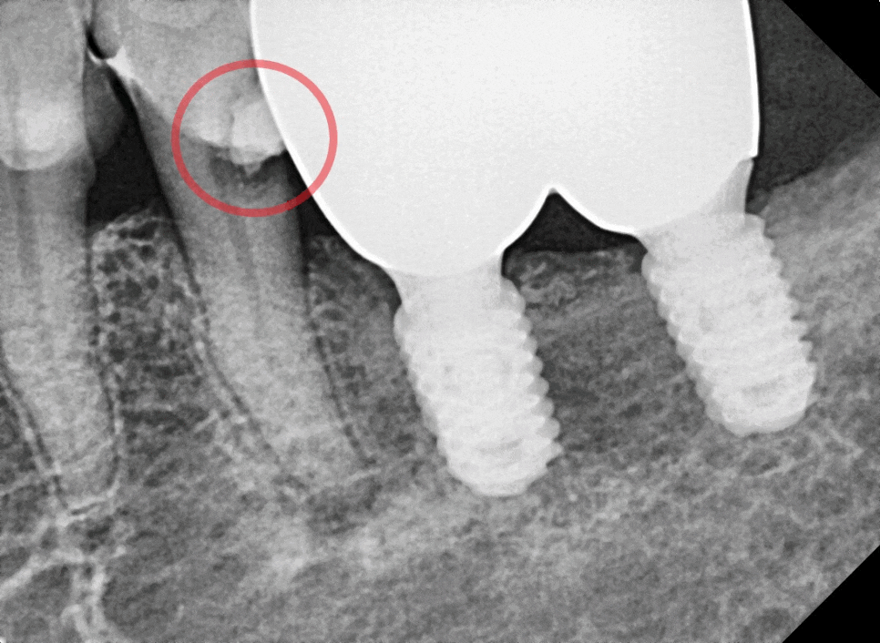 고덕동치과 임플란트 정기검진, 미루다가 수십만 원 손해 봅니다. 관련 이미지 6