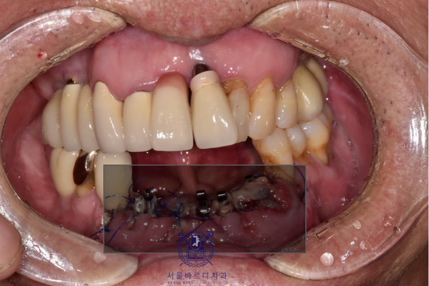 고덕동치과 서울바르디치과 전치부 및 구치부 임플란트 치료증례 #10 관련 이미지 11