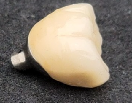 고덕동 임플란트 크라운 연결해서 만드는 이유는? 관련 이미지 7