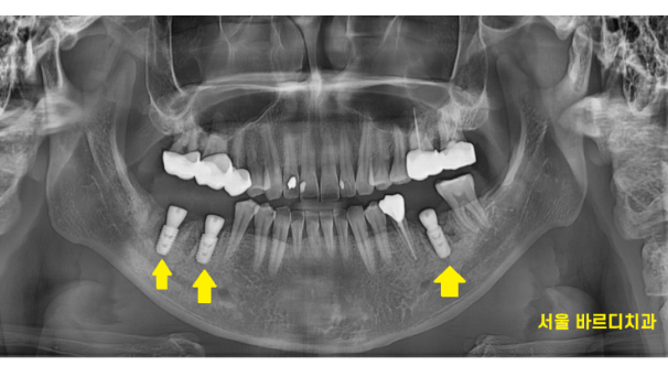강일동 치과 잇몸뼈 녹음 발치 후 임플란트로 해결했습니다. 관련 이미지 8
