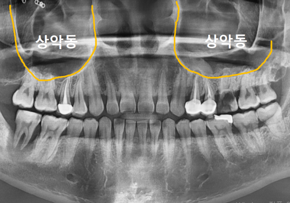 어금니 구멍, 충치 솔직하게 말씀드립니다. 치과 공포증으로 미루신 분들 필독 관련 이미지 6