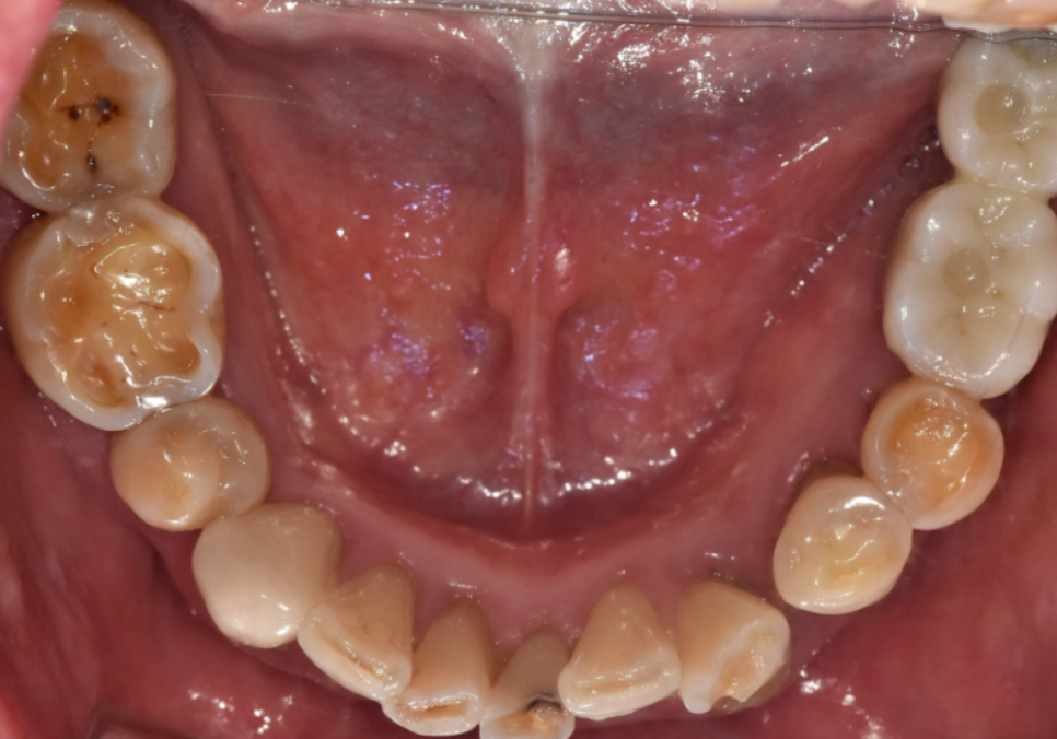 명일동 라미네이트 vs 크라운, 수명을 좌우하는 선택 기준 3가지 관련 이미지 3
