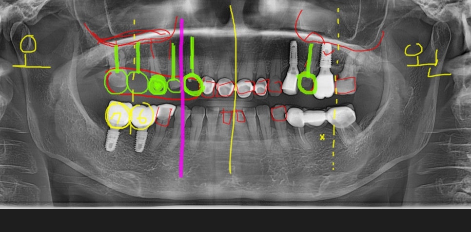 A Case of a 69-Year-Old Who Underwent Immediate Implant Placement After Extraction Due to Tooth Decay in Godeok-dong image 10