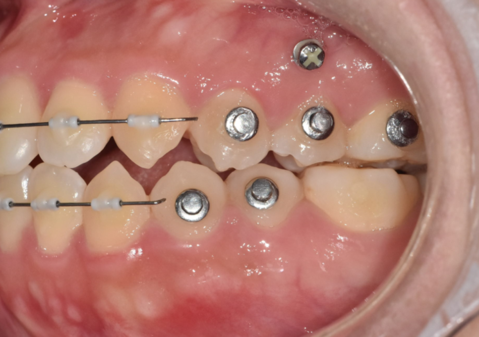 치아 교정 스크류 통증 의외로 이렇습니다. 관련 이미지 5