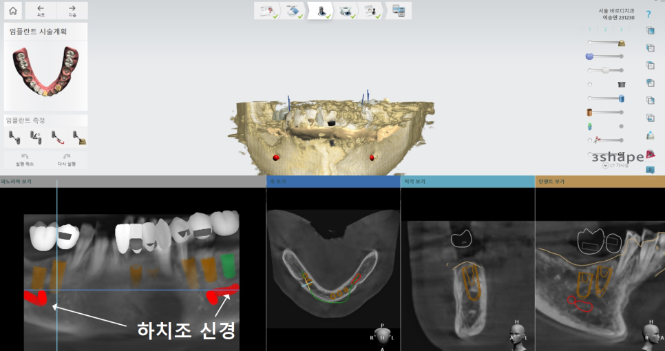 천호 디지털 가이드 임플란트, 일반 임플란트와 무슨 차이가 있나요? 관련 이미지 8