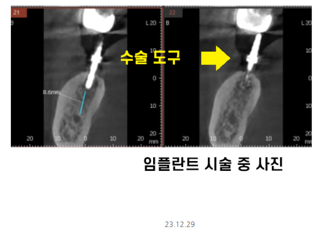 하남시청치과 내비게이션 임플란트 뭐가 좋아요?? 관련 이미지 6