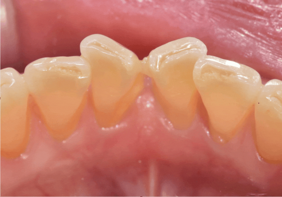 무삭제 라미네이트 적응증, 당신이 미처 몰랐던 시술의 조건을 공개합니다. 관련 이미지 5