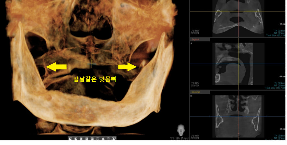 상일동 근처 치과 얇은뼈 틀니 안될 때 해결 방법은?? 관련 이미지 2