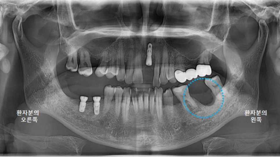 고덕동치과 서울바르디치과 전치부 및 구치부 임플란트 치료증례 #9 관련 이미지 4