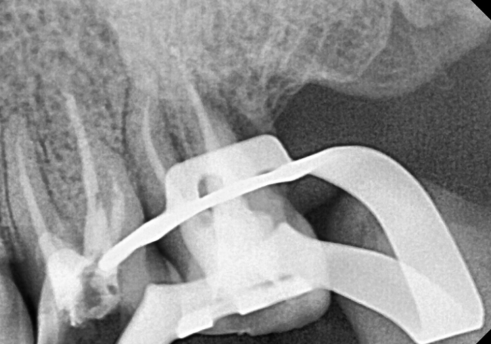 어금니 금 감, 치아 살릴 수 있는 기준은 바로 관련 이미지 9