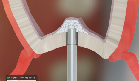 If you lightly brush your backmost molar because the toothbrush can’t reach it, this is what happens. image 12