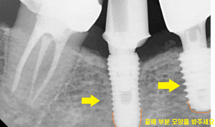 타치과 임플란트 as 수리 가능한 선동치과 관련 이미지 1