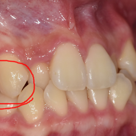 Sangil-dong Orthodontic Dentist: Do Protruding Front Teeth Really Need Orthodontic Treatment? image 1
