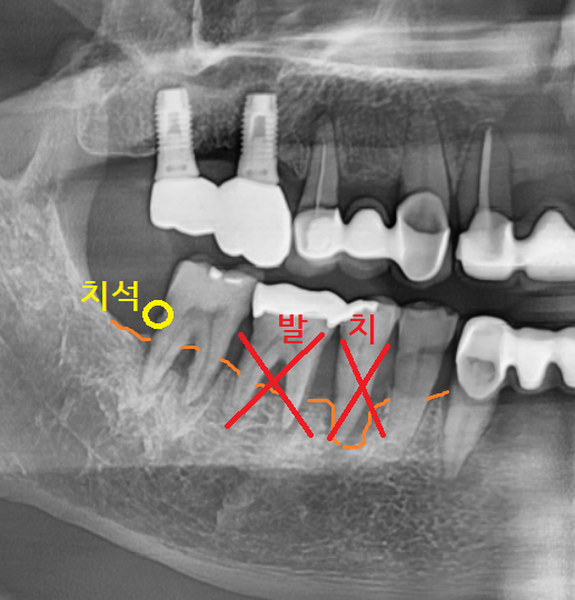 명일역 치과 움직이는 치아 치료 고정할 수 있을까? 관련 이미지 4