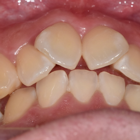 Sangil-dong Orthodontic Dentist: Do Protruding Front Teeth Really Need Orthodontic Treatment? image 2