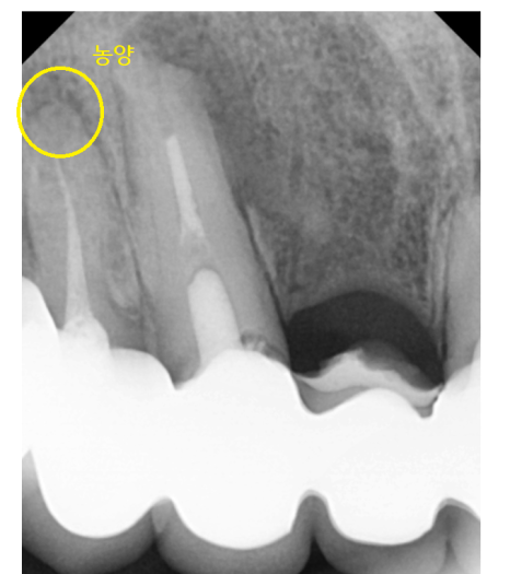 명일동 치과 뿌리 염증으로 입냄새가 나요 해결책은? 관련 이미지 3
