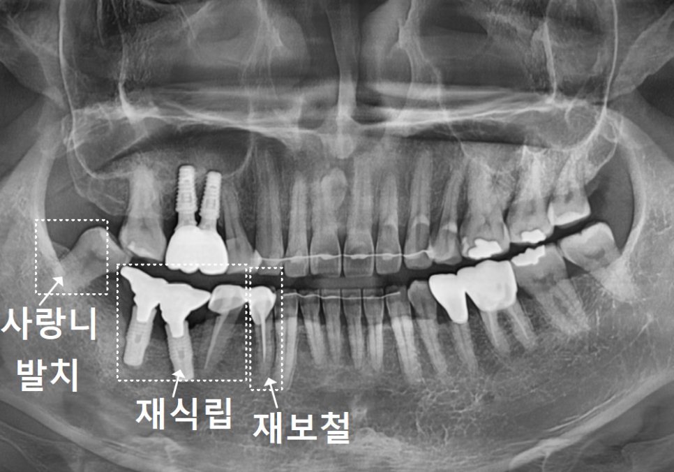 오래된 임플란트, 흔들림과 통증, 어떻게 하면 더 건강하게 쓸 수 있을까? 관련 이미지 10