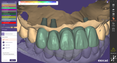 네비게이션 임플란트가 왜 좋다고 그러는거죠? (feat.13가지 장점) 관련 이미지 18