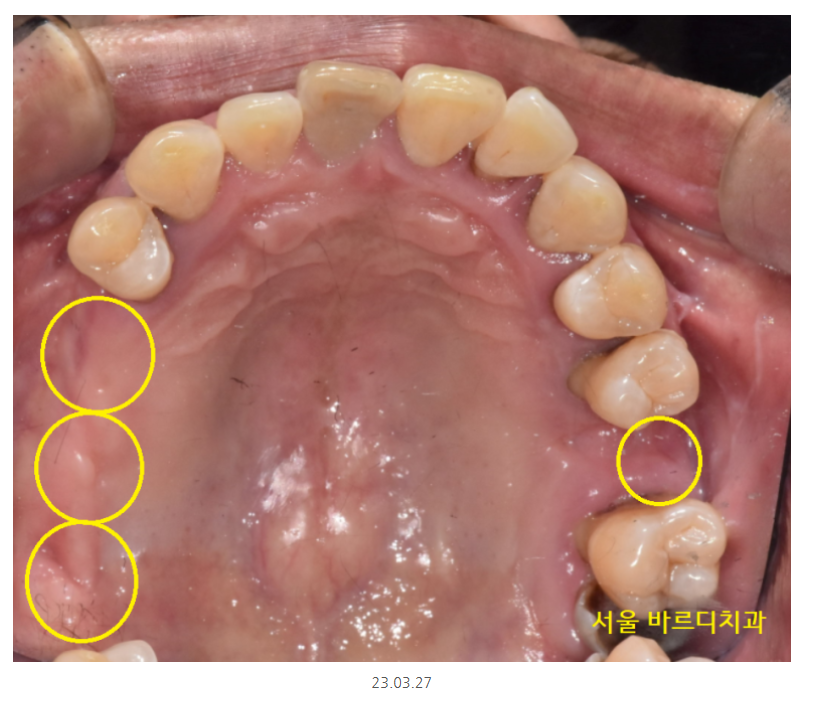 길동 치과 임플란트 뼈이식 흡연 관련 있을까? 관련 이미지 3