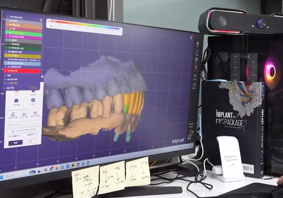 뼈가 없어서 안 된다구요? 70대 당뇨 무치악 환자분의 전체 임플란트 사례 관련 이미지 14